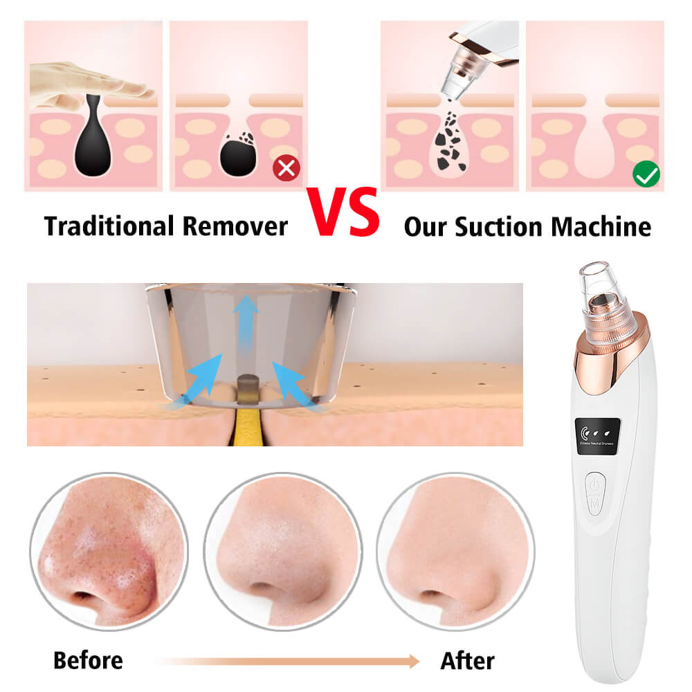 Facial Pore Vacuum – Blackhead & Acne Remover