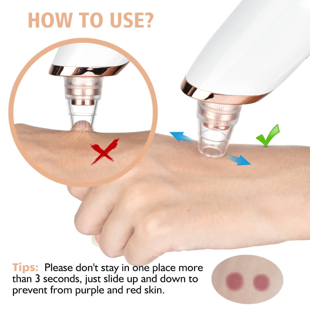 Facial Pore Vacuum – Blackhead & Acne Remover